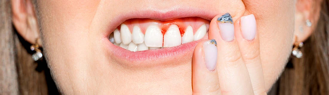 Why Your Gums Might Be Bleeding In Wall Township NJ & What You Should Do About It