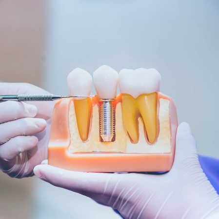 Cutaway Of Dental Implants